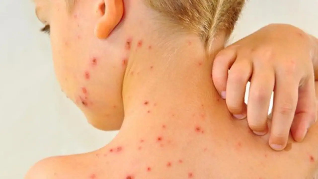 ചിക്കൻ പോക്‌സ് സൂക്ഷിക്കണേ; ശ്രദ്ധിക്കേണ്ട കാര്യങ്ങൾ