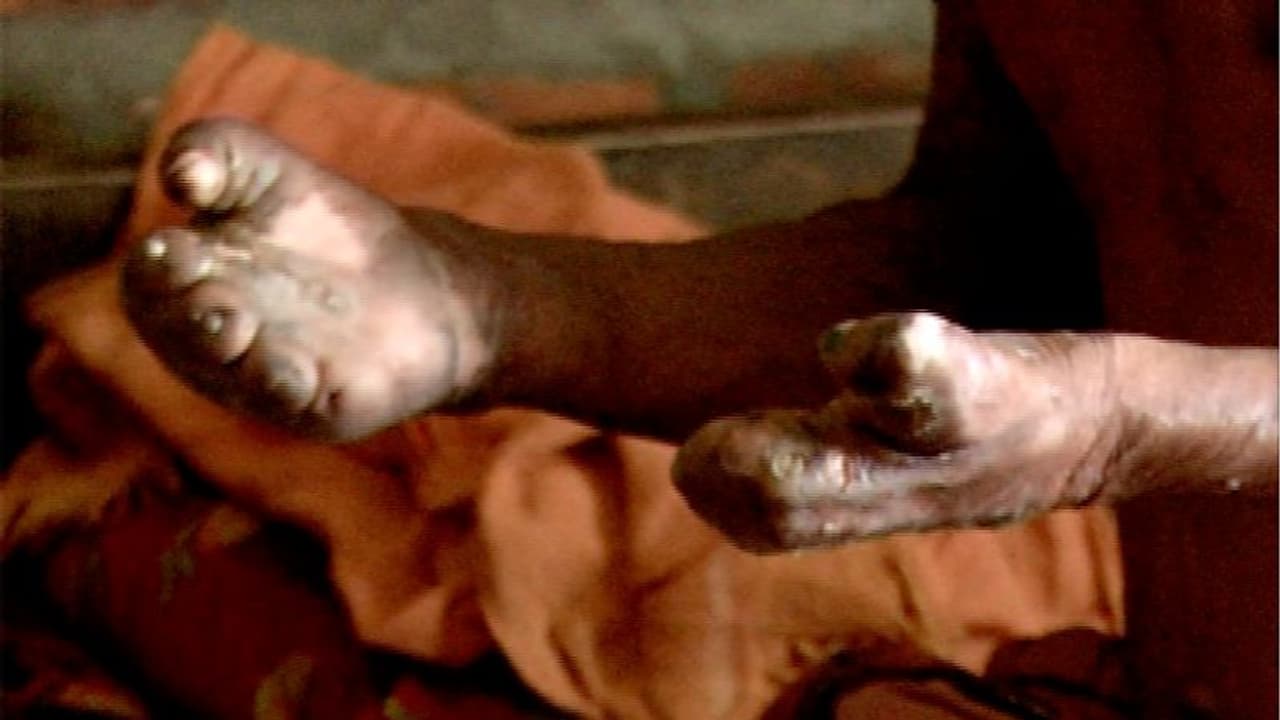 ಚಿಕ್ಕಬಳ್ಳಾಪುರದಲ್ಲಿ 66 ಕುಷ್ಠ ರೋಗ ಪ್ರಕರಣ ಪತ್ತೆ ಚಿಕ್ಕಬಳ್ಳಾಪುರದಲ್ಲಿ 66 ಕುಷ್ಠ ರೋಗ ಪ್ರಕರಣ ಪತ್ತೆ