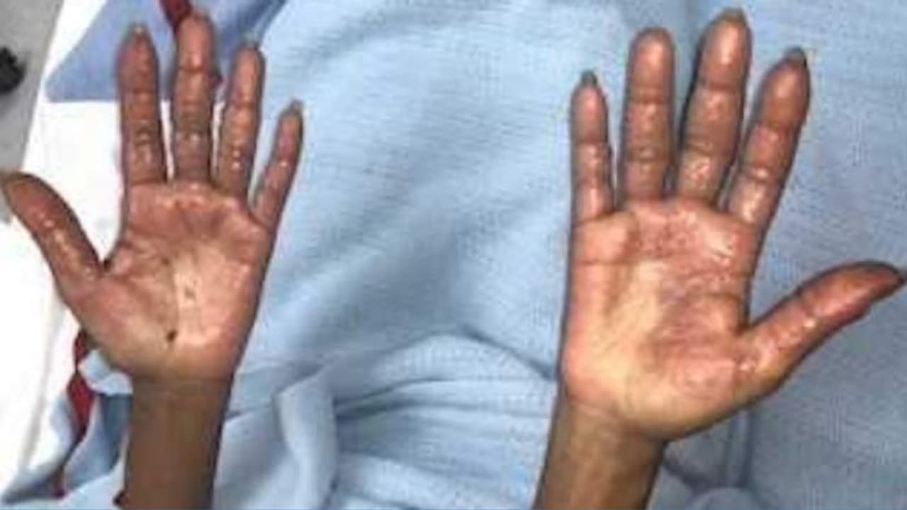 മുടി ഡൈ ചെയ്യുന്നതിനിടെ ഗുരുതരമായി പൊള്ളലേറ്റ യുവതി ആശുപത്രിയില്; മുന്നറിയിപ്പുമായി ഡോക്ടര്മാര് മുടി ഡൈ ചെയ്യുന്നതിനിടെ ഗുരുതരമായി പൊള്ളലേറ്റ യുവതി ആശുപത്രിയില്; മുന്നറിയിപ്പുമായി ഡോക്ടര്മാര്