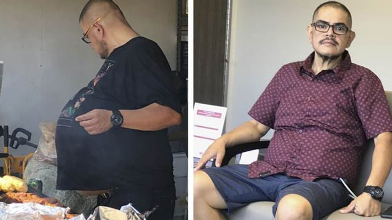 കുടവയർ ആണെന്ന് ആദ്യം കരുതി; പക്ഷേ, ഡോക്ടർമാർ വയർ പരിശോധിച്ചപ്പോൾ കണ്ടെത്തിയത് 34 കി.ഗ്രാം ഭാരമുളള മുഴ കുടവയർ ആണെന്ന് ആദ്യം കരുതി; പക്ഷേ, ഡോക്ടർമാർ വയർ പരിശോധിച്ചപ്പോൾ കണ്ടെത്തിയത് 34 കി.ഗ്രാം ഭാരമുളള മുഴ