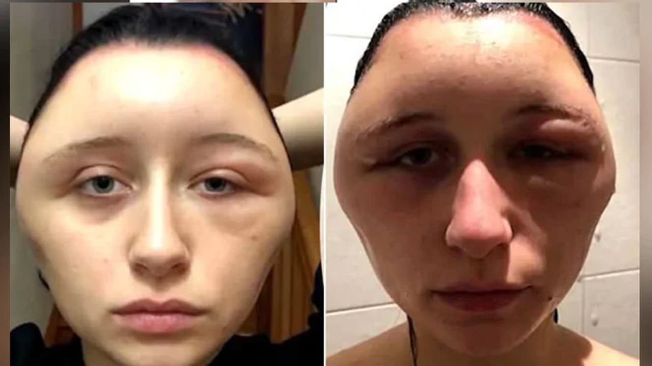 ಎಚ್ಚರ..! ಹೇರ್ ಡೈ ಡೇಂಜರ್: ಬುಲ್ಡೆ ಸೈಜೇ ಬದಲಾಗುತ್ತೆ! ಎಚ್ಚರ..! ಹೇರ್ ಡೈ ಡೇಂಜರ್: ಬುಲ್ಡೆ ಸೈಜೇ ಬದಲಾಗುತ್ತೆ!