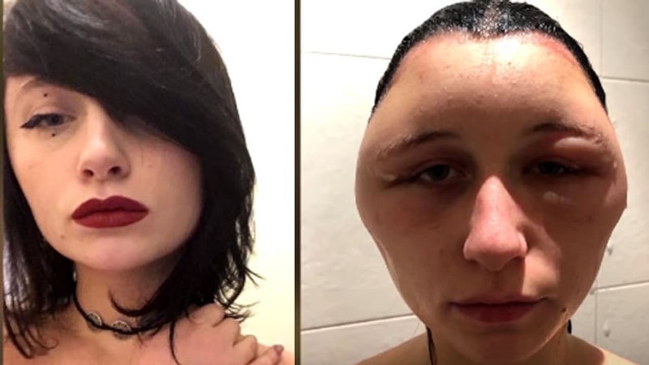 ഹെയർ ഡൈ ഉപയോഗിച്ച യുവതിയുടെ മുഖം 'ബൾബ്' പോലെയായി; വീഡിയോ ഹെയർ ഡൈ ഉപയോഗിച്ച യുവതിയുടെ മുഖം 'ബൾബ്' പോലെയായി; വീഡിയോ