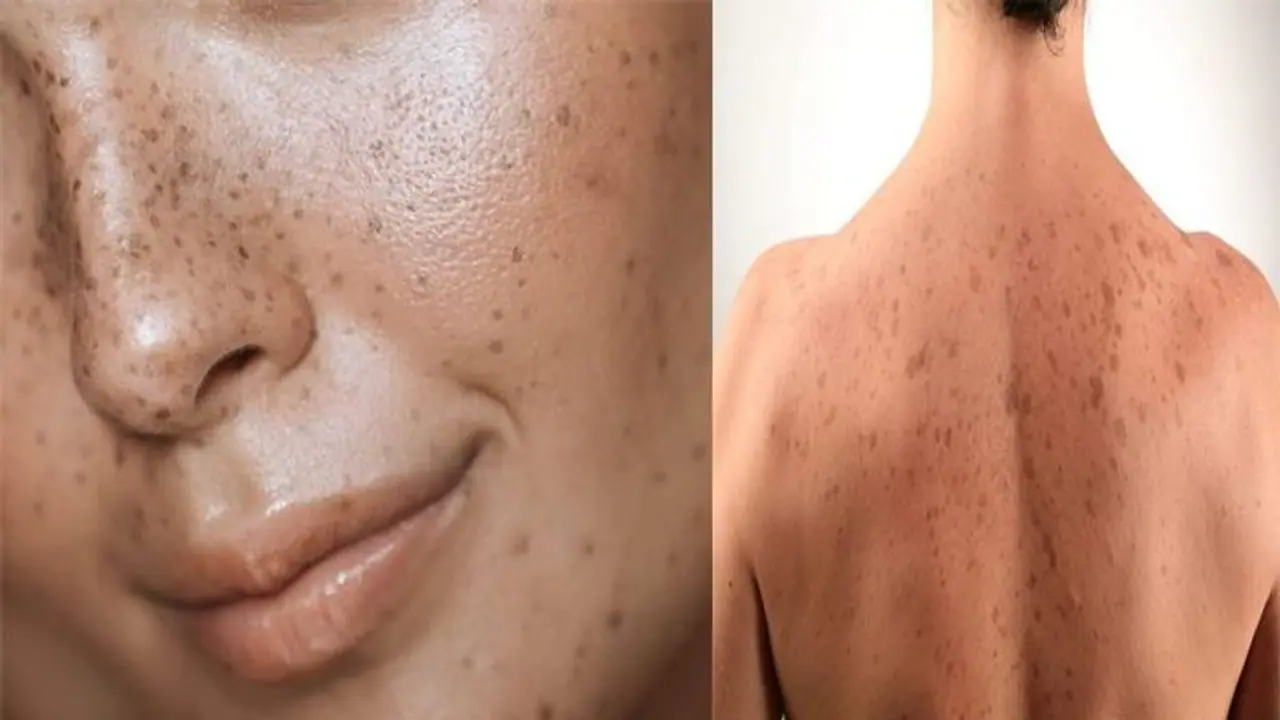 ಚರ್ಮಕ್ಕೇಕೆ ಕಂದು ಕಲೆಯ ಕಾಟ? ಚರ್ಮಕ್ಕೇಕೆ ಕಂದು ಕಲೆಯ ಕಾಟ?