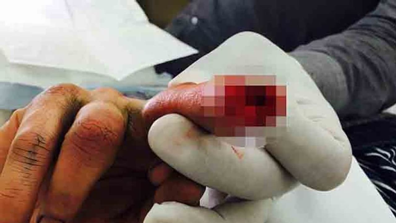 సైడ్ అడిగినందుకు.. వేలు కొరికేశాడు సైడ్ అడిగినందుకు.. వేలు కొరికేశాడు