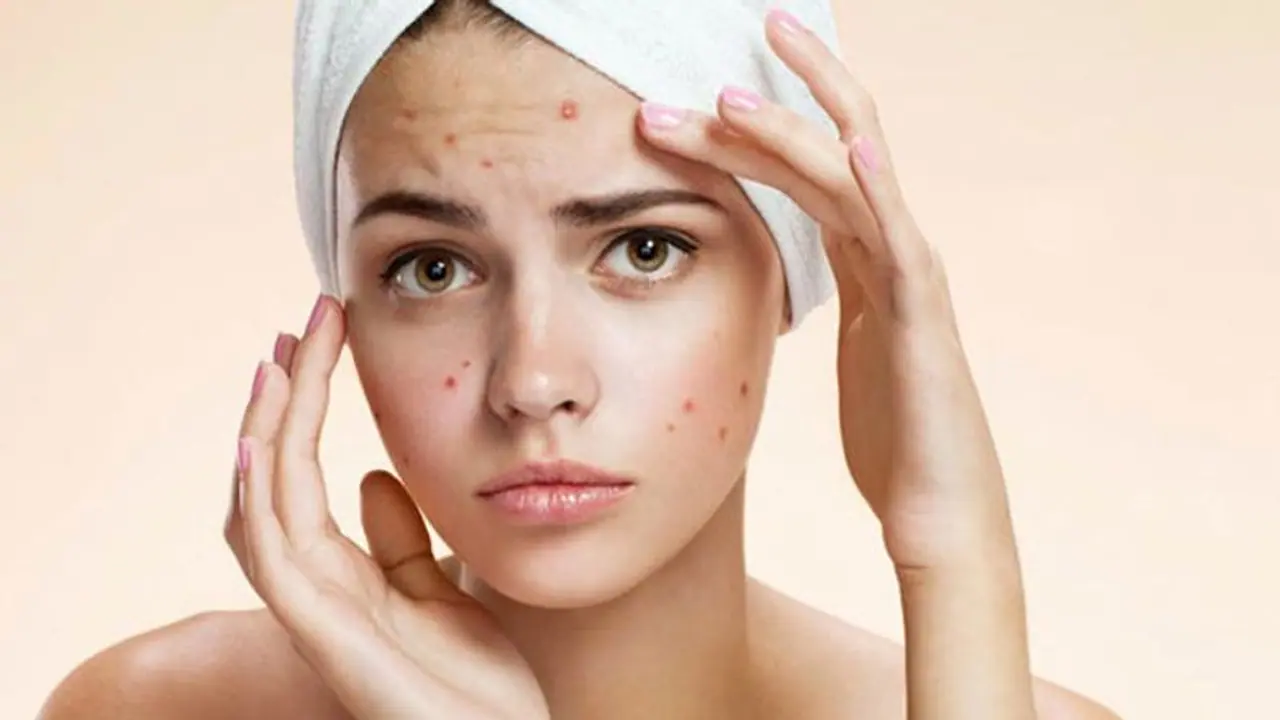మొటిమలతో ముఖంపై గుంతలా..? ఇదిగో పరిష్కారం మొటిమలతో ముఖంపై గుంతలా..? ఇదిగో పరిష్కారం