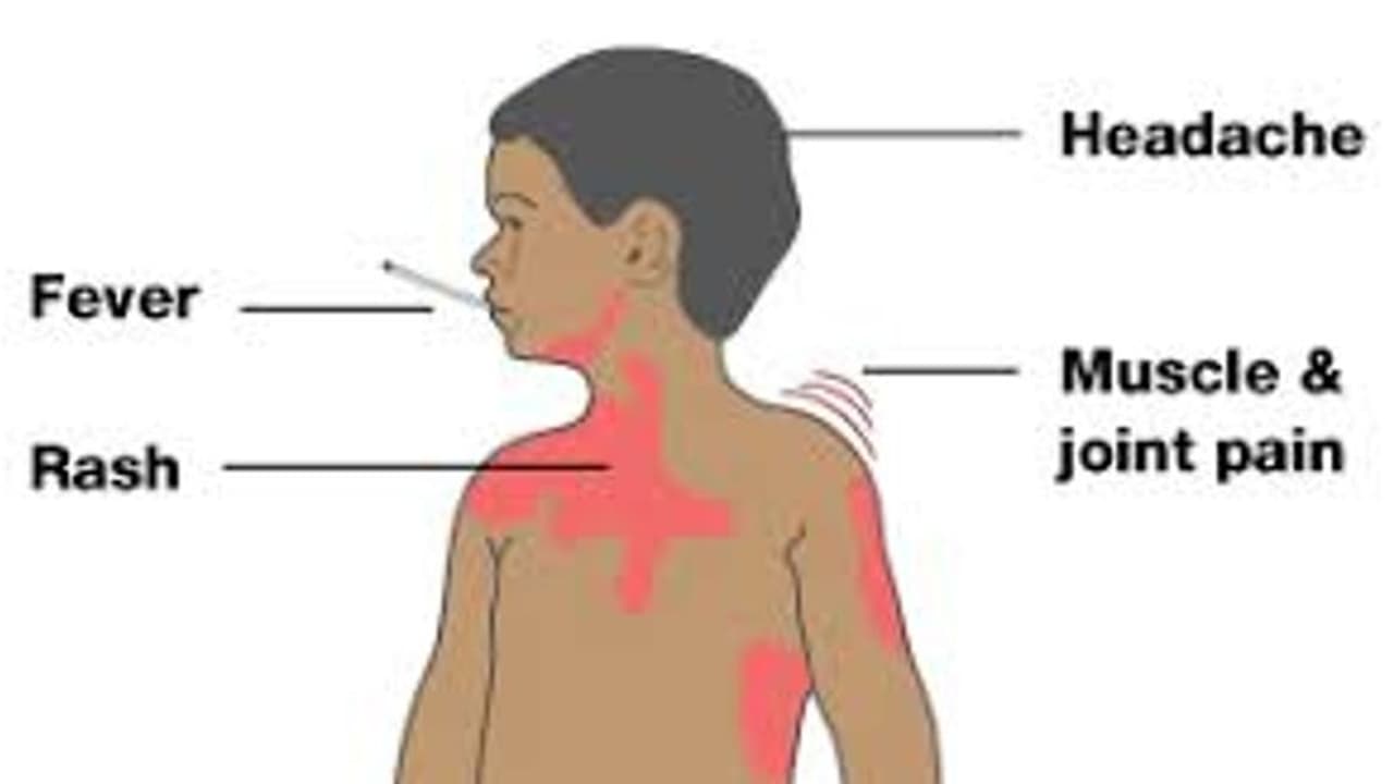 டெங்கு வந்தால் மிக ஈஸியா நீங்களே கண்டுப்பிடிக்கலாம்..! எப்படி தெரியுமா..? டெங்கு வந்தால் மிக ஈஸியா நீங்களே கண்டுப்பிடிக்கலாம்..! எப்படி தெரியுமா..?