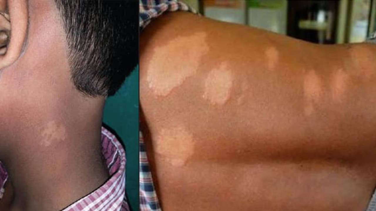 World Leprosy Day 2023 : ലോക കുഷ്ഠരോഗ ദിനം; അറിയാം രോഗലക്ഷണങ്ങൾ, പ്രതിരോധം...