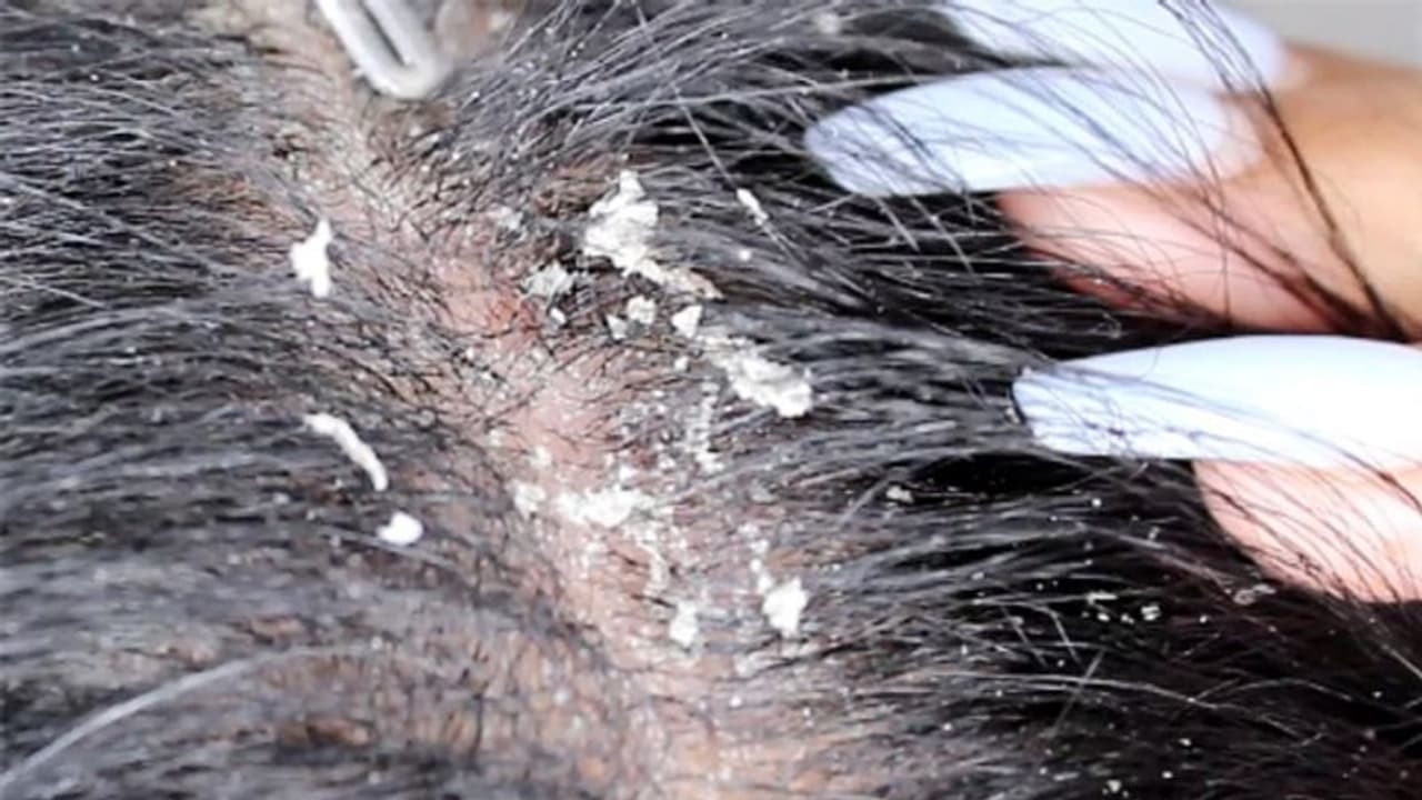 താരന്റെ ശല്യം ഇനി ഉണ്ടാകില്ല; ഇതാ ഒരു എളുപ്പവഴി താരന്റെ ശല്യം ഇനി ഉണ്ടാകില്ല; ഇതാ ഒരു എളുപ്പവഴി