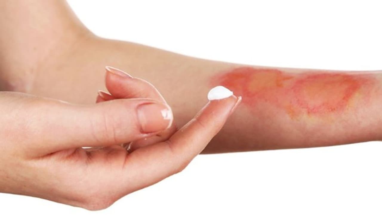 പൊള്ളലേറ്റാൽ ചെയ്യേണ്ടതും ചെയ്യാൻ പാടില്ലാത്തതും പൊള്ളലേറ്റാൽ ചെയ്യേണ്ടതും ചെയ്യാൻ പാടില്ലാത്തതും