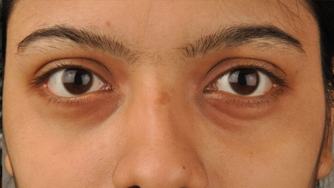 'ഡാര്ക് സര്ക്കിള്സ്' മാറാൻ വീട്ടില് എളുപ്പത്തില് ചെയ്തുനോക്കാവുന്ന പൊടിക്കൈകള്... 'ഡാര്ക് സര്ക്കിള്സ്' മാറാൻ വീട്ടില് എളുപ്പത്തില് ചെയ്തുനോക്കാവുന്ന പൊടിക്കൈകള്...