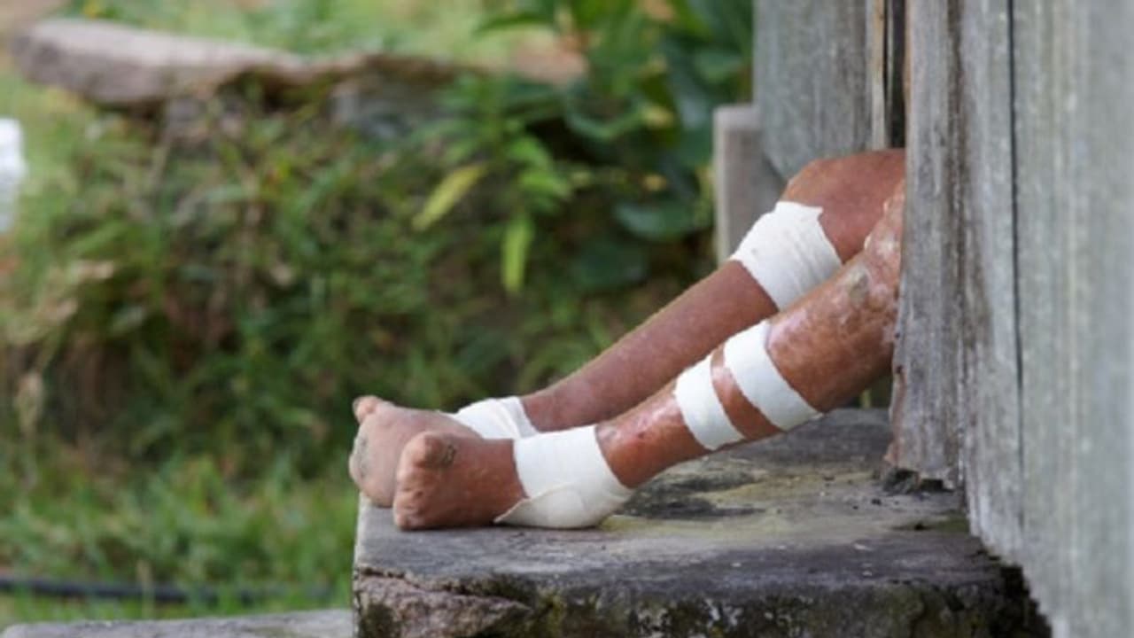 World Leprosy Day: With India battling over 1 lakh cases, WHO calls for eliminating prejudice World Leprosy Day: With India battling over 1 lakh cases, WHO calls for eliminating prejudice