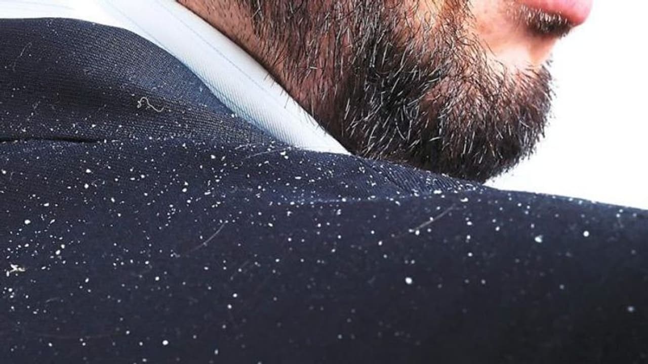 ഇനി താരന്റെ ശല്യം ഉണ്ടാകില്ല; ഇതാ 12 നാടന് വഴികള് ഇനി താരന്റെ ശല്യം ഉണ്ടാകില്ല; ഇതാ 12 നാടന് വഴികള്