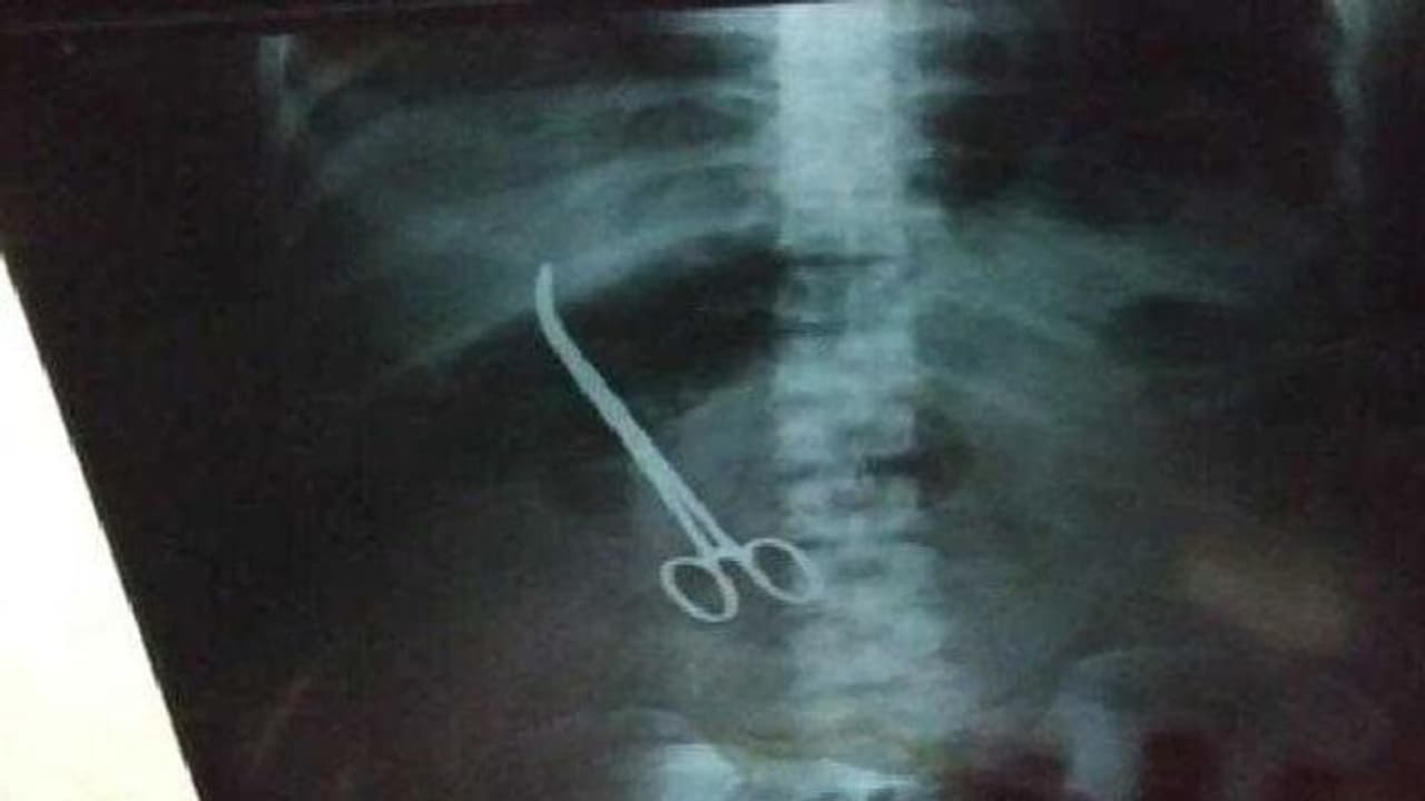 ಶಸ್ತ್ರಚಿಕಿತ್ಸೆ ವೇಳೆ ಹೊಟ್ಟೆಯಲ್ಲೇ ಎರಡು ಕತ್ತರಿ ಬಿಟ್ಟ ವೈದ್ಯರು! ಶಸ್ತ್ರಚಿಕಿತ್ಸೆ ವೇಳೆ ಹೊಟ್ಟೆಯಲ್ಲೇ ಎರಡು ಕತ್ತರಿ ಬಿಟ್ಟ ವೈದ್ಯರು!