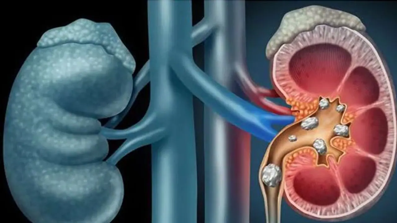 কিডনিতে স্টোন? এই ৭টি ঘরোয়া উপায়ে সারিয়ে ফেলুন সমস্যা কিডনিতে স্টোন? এই ৭টি ঘরোয়া উপায়ে সারিয়ে ফেলুন সমস্যা