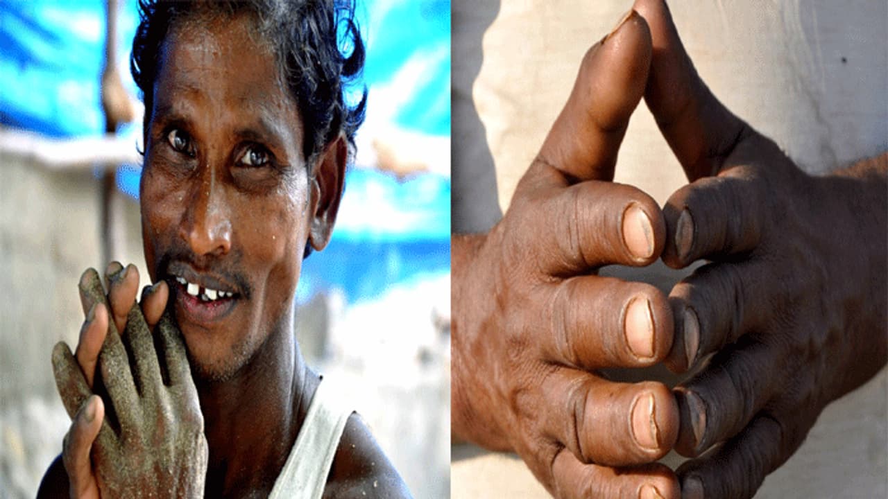 వింత అనుభవం: వేలిముద్రలు కనబడుటలేదు వింత అనుభవం: వేలిముద్రలు కనబడుటలేదు