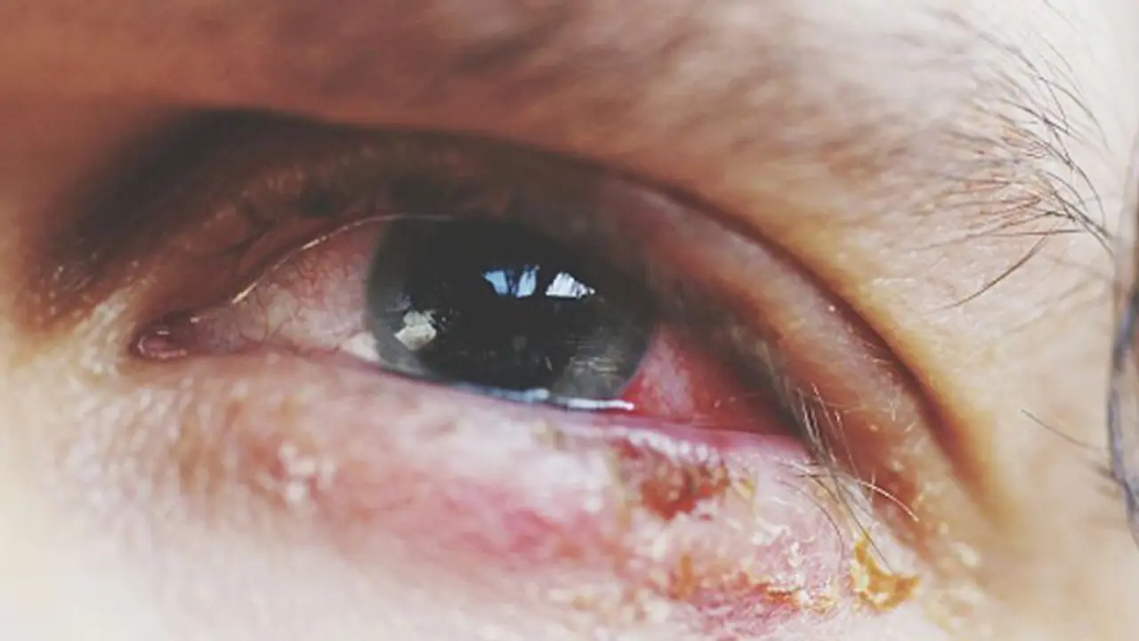 Pink eye stares people of Bengaluru in the face this summer, number of cases increases steadily Pink eye stares people of Bengaluru in the face this summer, number of cases increases steadily