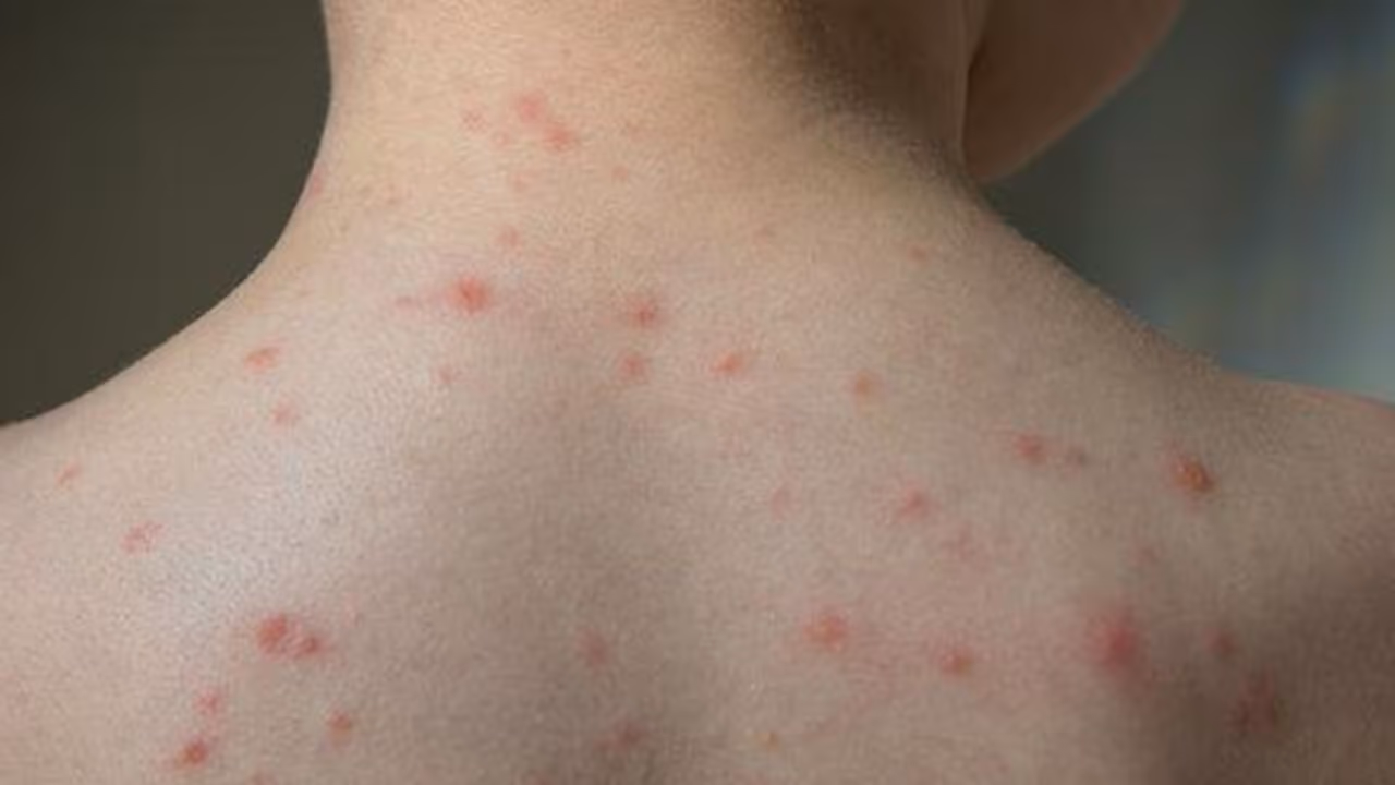 ചിക്കൻപോക്സ്; ലക്ഷണങ്ങളും ശ്രദ്ധിക്കേണ്ട കാര്യങ്ങളും ചിക്കൻപോക്സ്; ലക്ഷണങ്ങളും ശ്രദ്ധിക്കേണ്ട കാര്യങ്ങളും