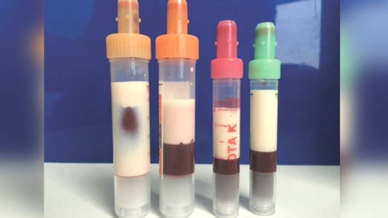 രക്തത്തിന് പാല് നിറം; രോഗിയെ പരിശോധിച്ച ഡോക്ടര്മാര് ഞെട്ടി രക്തത്തിന് പാല് നിറം; രോഗിയെ പരിശോധിച്ച ഡോക്ടര്മാര് ഞെട്ടി