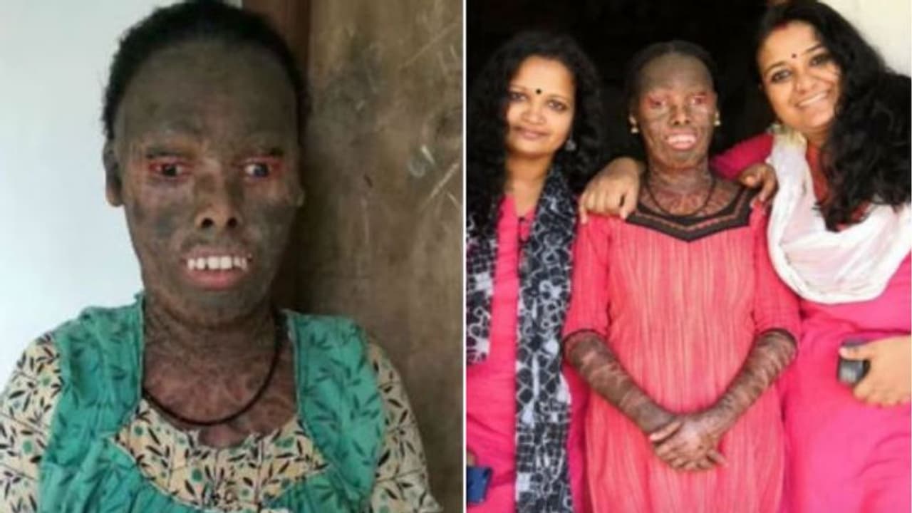 ഇനി ഈ മുഖം വാടേണ്ട; പുതിയ ജീവിതത്തിലേക്ക് പ്രീതി... ഇനി ഈ മുഖം വാടേണ്ട; പുതിയ ജീവിതത്തിലേക്ക് പ്രീതി...