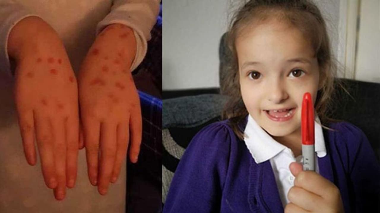 പരീക്ഷാപ്പേടി: ചിക്കന്പോക്സാണെന്ന് തെറ്റിദ്ധരിപ്പിക്കാന് ഉപയോഗിച്ചത് പെര്മനന്റ് മാര്ക്കര് പരീക്ഷാപ്പേടി: ചിക്കന്പോക്സാണെന്ന് തെറ്റിദ്ധരിപ്പിക്കാന് ഉപയോഗിച്ചത് പെര്മനന്റ് മാര്ക്കര്