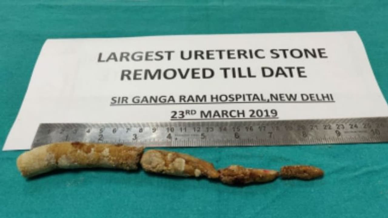 ഒരു മൂത്രക്കല്ലിന്റെ വലിപ്പം 22 സെ.മീ; അമ്പരന്ന് ഡോക്ടര്മാരും... ഒരു മൂത്രക്കല്ലിന്റെ വലിപ്പം 22 സെ.മീ; അമ്പരന്ന് ഡോക്ടര്മാരും...