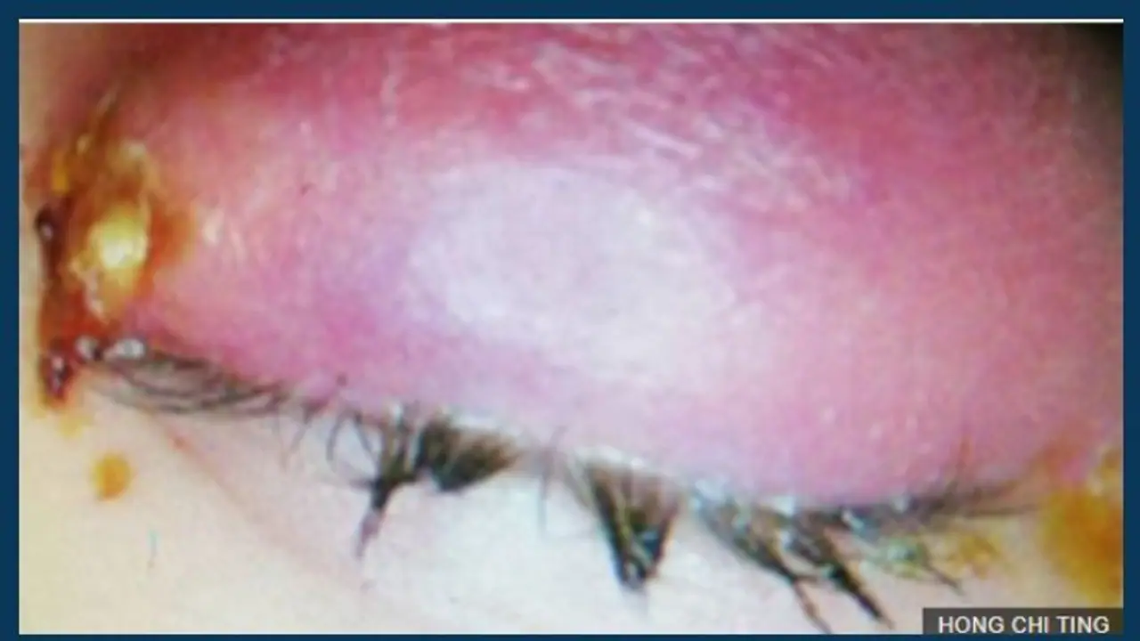 യുവതിയുടെ കണ്ണില് ജീവിച്ചിരുന്ന നാല് തേനീച്ചകളെ ഡോക്ടര്മാര് നീക്കം ചെയ്തു യുവതിയുടെ കണ്ണില് ജീവിച്ചിരുന്ന നാല് തേനീച്ചകളെ ഡോക്ടര്മാര് നീക്കം ചെയ്തു