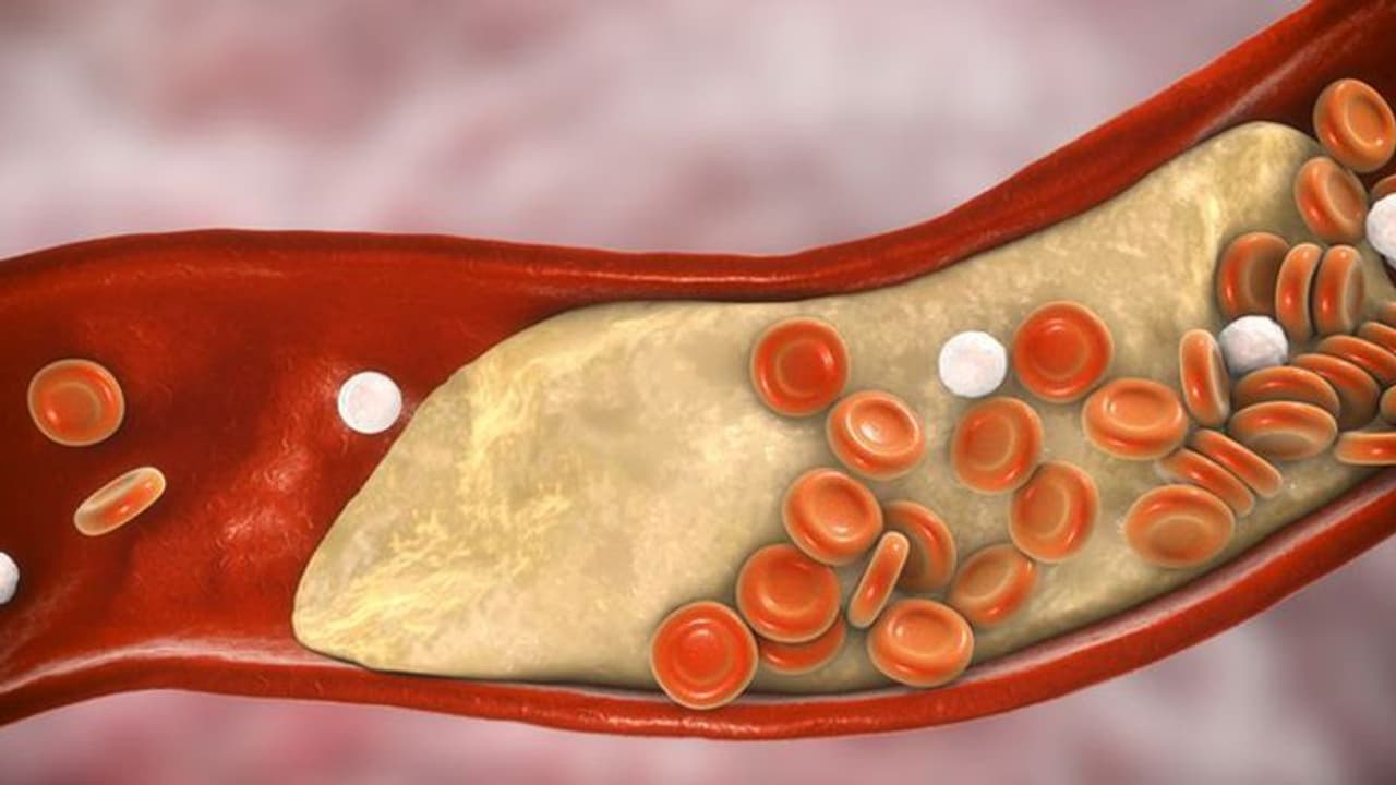 കൊളസ്ട്രോൾ കുറയ്ക്കാൻ ഇതാ 5 എളുപ്പ വഴികൾ... കൊളസ്ട്രോൾ കുറയ്ക്കാൻ ഇതാ 5 എളുപ്പ വഴികൾ...