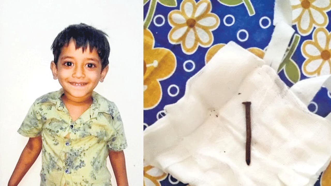 బాలుడి గొంతులో మేకు.. ఆపరేషన్ చేసి బయటకు తీశారు బాలుడి గొంతులో మేకు.. ఆపరేషన్ చేసి బయటకు తీశారు