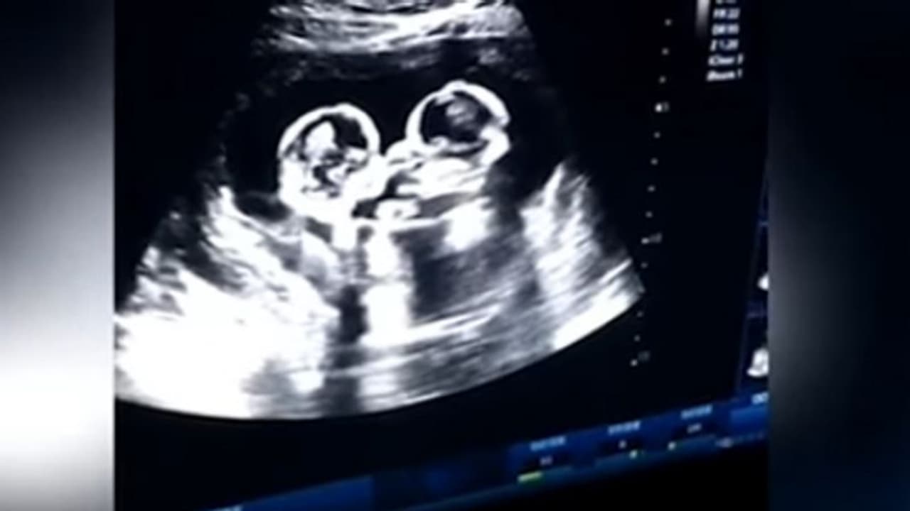 பிறப்பதற்க்கு முன்பே தாயின் வயிற்றில் சண்டையிட்ட இரட்டை குழந்தைகள்! வைரலாகும் காட்சி! பிறப்பதற்க்கு முன்பே தாயின் வயிற்றில் சண்டையிட்ட இரட்டை குழந்தைகள்! வைரலாகும் காட்சி!