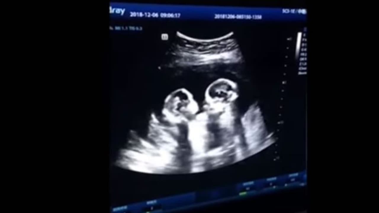 അമ്മയുടെ ഗര്ഭപാത്രത്തില് കിടന്ന് അടികൂടുന്ന ഇരട്ടകള്; സ്കാനിംഗ് വീഡിയോ വൈറല് അമ്മയുടെ ഗര്ഭപാത്രത്തില് കിടന്ന് അടികൂടുന്ന ഇരട്ടകള്; സ്കാനിംഗ് വീഡിയോ വൈറല്