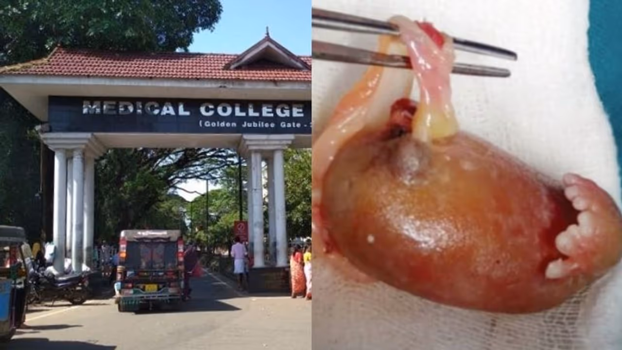 45 ദിവസം പ്രായമുള്ള ആണ്കുഞ്ഞിന്റെ വയറ്റില് ഭ്രൂണാവസ്ഥയിലുള്ള ശിശു 45 ദിവസം പ്രായമുള്ള ആണ്കുഞ്ഞിന്റെ വയറ്റില് ഭ്രൂണാവസ്ഥയിലുള്ള ശിശു