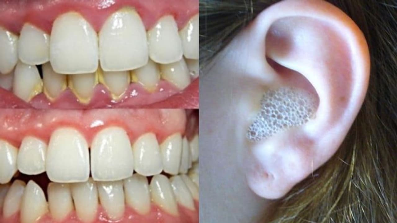 പല്ലിലെ മഞ്ഞനിറം അകറ്റാനും ചെവിക്കായം വൃത്തിയാക്കാനും ഒരു എളുപ്പവഴി