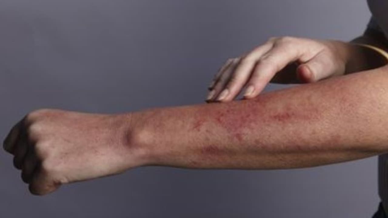 ലൂപ്പസ് രോഗത്തിന്റെ ശ്രദ്ധിക്കാതെ പോകുന്ന ലക്ഷണങ്ങള് ലൂപ്പസ് രോഗത്തിന്റെ ശ്രദ്ധിക്കാതെ പോകുന്ന ലക്ഷണങ്ങള്