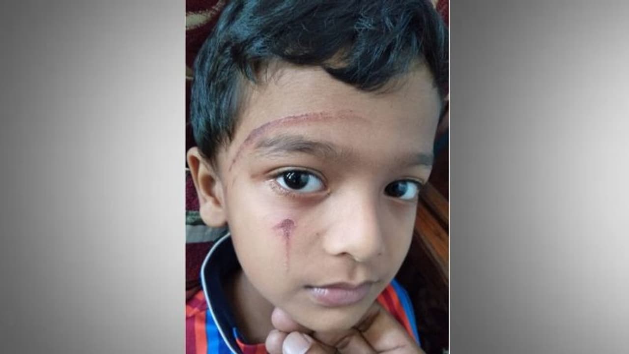 വീട്ടുമുറ്റത്ത് കളിച്ചുകൊണ്ടിരുന്ന ആറുവയസ്സുകാരന് സൂര്യതാപമേറ്റു വീട്ടുമുറ്റത്ത് കളിച്ചുകൊണ്ടിരുന്ന ആറുവയസ്സുകാരന് സൂര്യതാപമേറ്റു