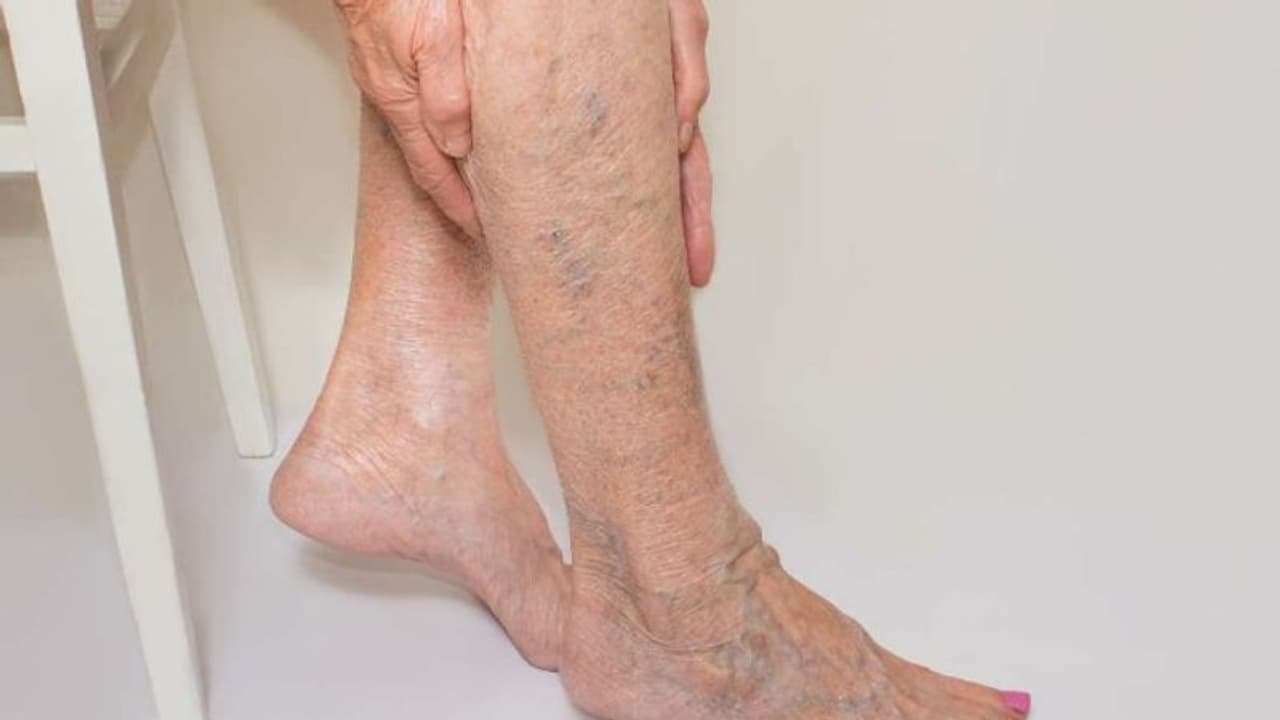 വെരിക്കോസ് വെയിൻ; ശ്രദ്ധിക്കേണ്ട ചില കാര്യങ്ങൾ വെരിക്കോസ് വെയിൻ; ശ്രദ്ധിക്കേണ്ട ചില കാര്യങ്ങൾ