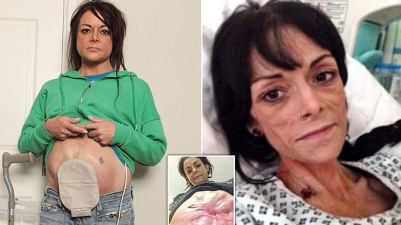 സിസേറിയന് ചെയ്ത ഭാഗത്തിലൂടെ ആന്തരികാവയവങ്ങള് മലത്തോടൊപ്പം പുറത്തേക്ക്, പല അവയവങ്ങളും പ്രവര്ത്തനരഹിതം, അപൂർവരോഗവുമായി 43കാരി സിസേറിയന് ചെയ്ത ഭാഗത്തിലൂടെ ആന്തരികാവയവങ്ങള് മലത്തോടൊപ്പം പുറത്തേക്ക്, പല അവയവങ്ങളും പ്രവര്ത്തനരഹിതം, അപൂർവരോഗവുമായി 43കാരി