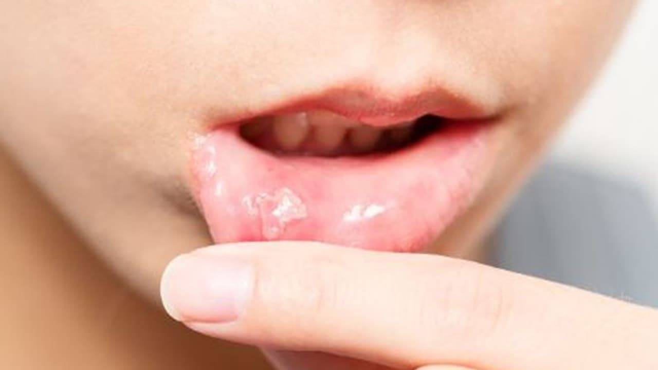 വായിലെ ക്യാൻസർ; ഈ ലക്ഷണങ്ങൾ കണ്ടാൽ നിസാരമാക്കരുത് വായിലെ ക്യാൻസർ; ഈ ലക്ഷണങ്ങൾ കണ്ടാൽ നിസാരമാക്കരുത്