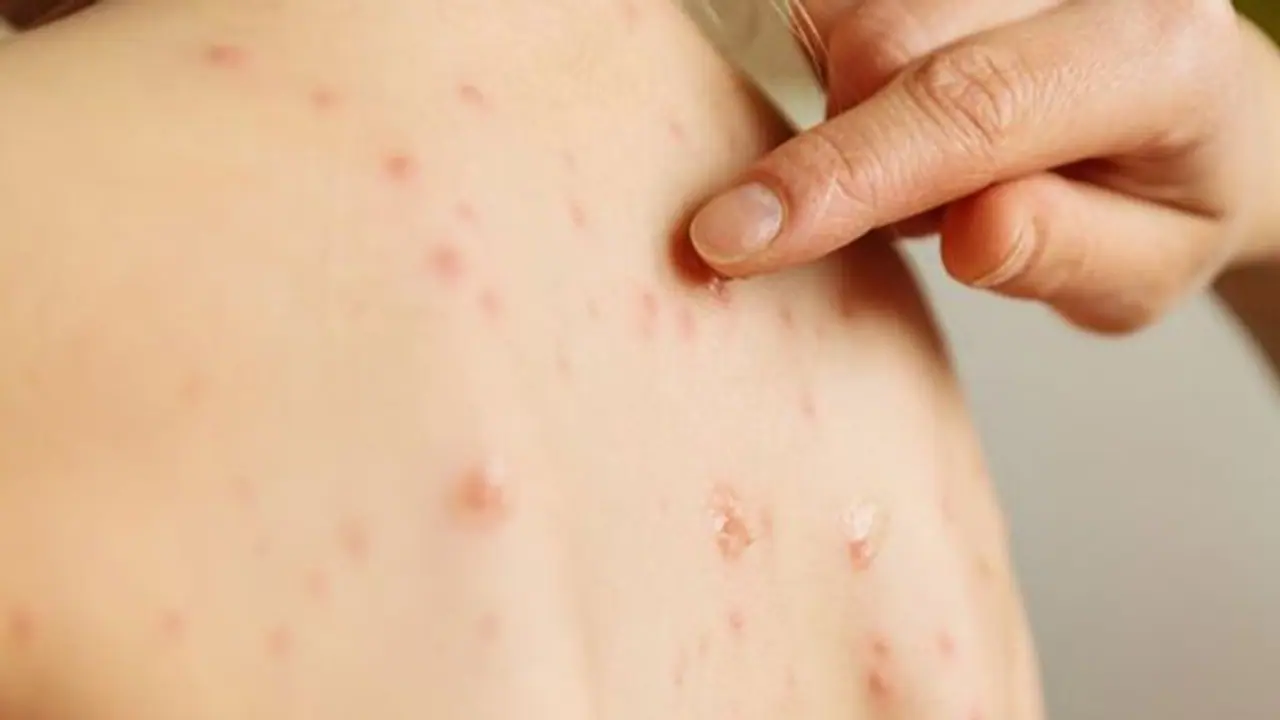 കുട്ടികളിലെ അ‍ഞ്ചാംപനി വില്ലനാകുന്നത് എപ്പോള്‍?; മാതാപിതാക്കള്‍ അറിയേണ്ട കാര്യങ്ങള്‍...