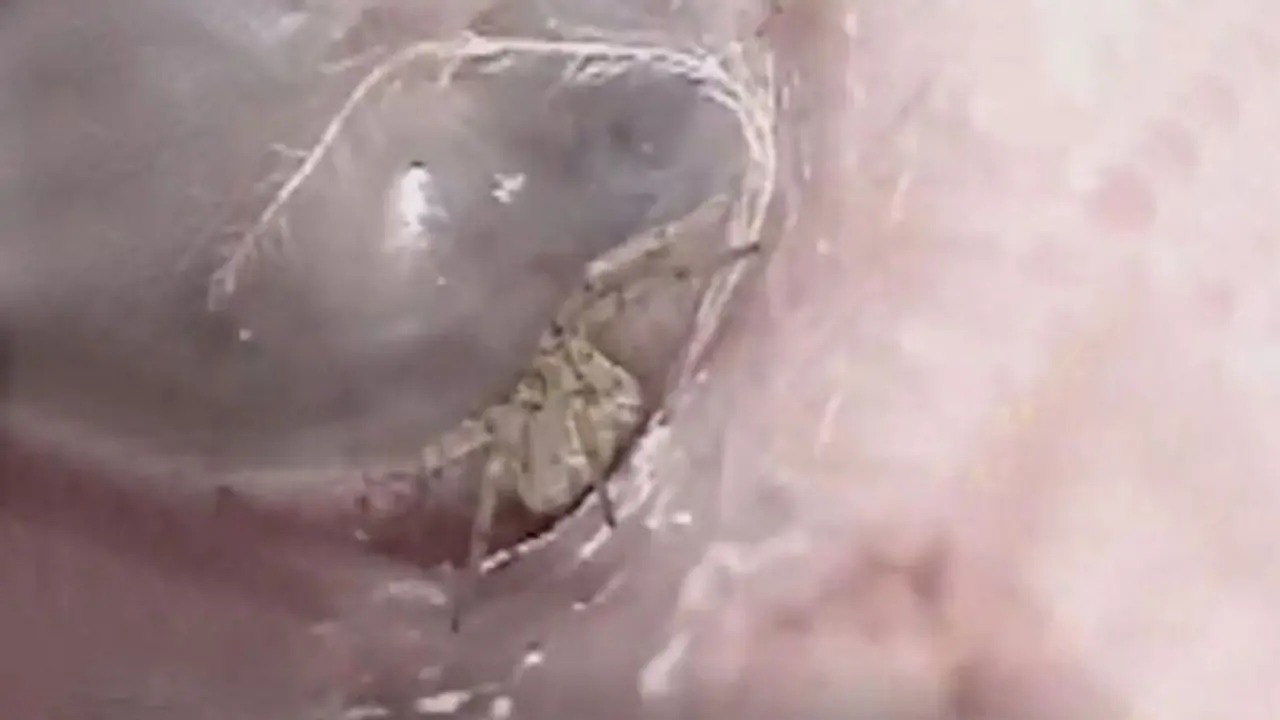 ചെവി ചൊറിയുന്നെന്ന് രോഗി; ഡോക്ടർക്ക് കിട്ടിയത് ജീവനുള്ള എട്ടുകാലിയെ ചെവി ചൊറിയുന്നെന്ന് രോഗി; ഡോക്ടർക്ക് കിട്ടിയത് ജീവനുള്ള എട്ടുകാലിയെ