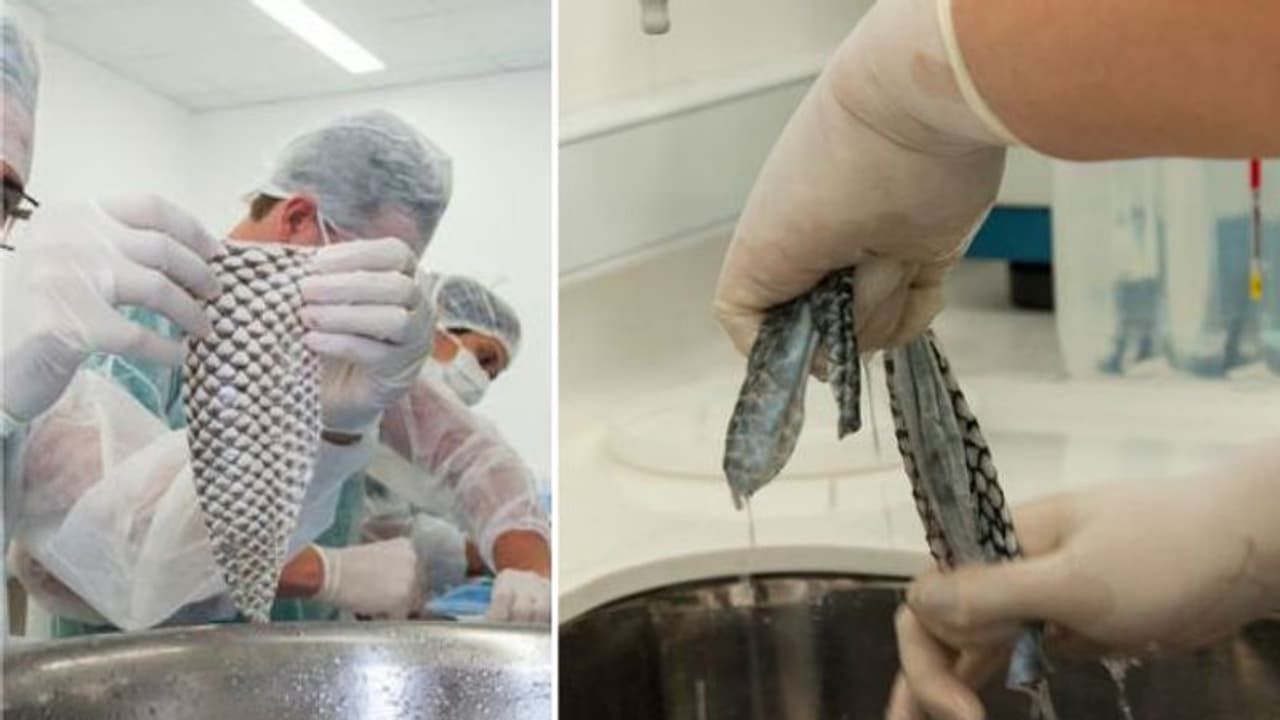 ജനനേന്ദ്രിയം ഘടന വരുത്താന് മീനിന്റെ തൊലി; ട്രാന്സ് വുമണിന്റെ ശസ്ത്രക്രിയ വിജയം ജനനേന്ദ്രിയം ഘടന വരുത്താന് മീനിന്റെ തൊലി; ട്രാന്സ് വുമണിന്റെ ശസ്ത്രക്രിയ വിജയം