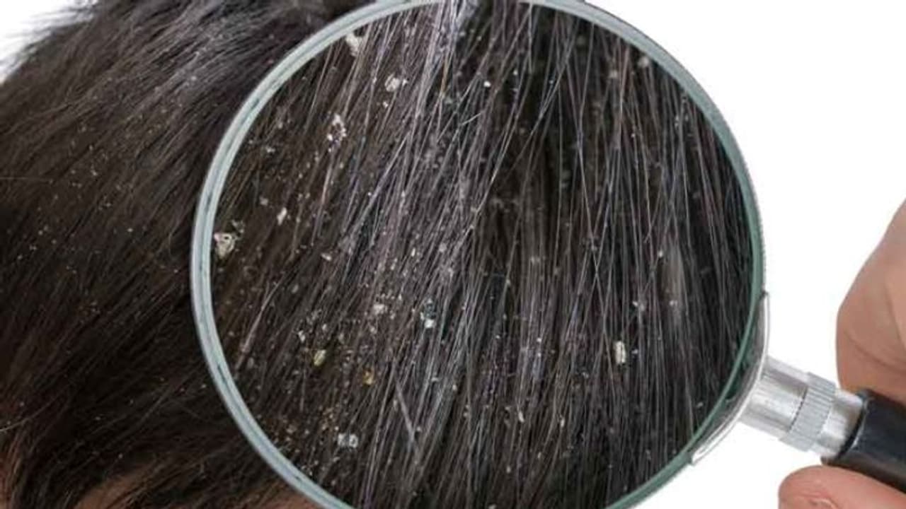 মাত্র ৭ দিনে মুক্তি পান খুসকির সমস্যা থেকে, রইল কার্যকরী ঘরোয়া সমাধান