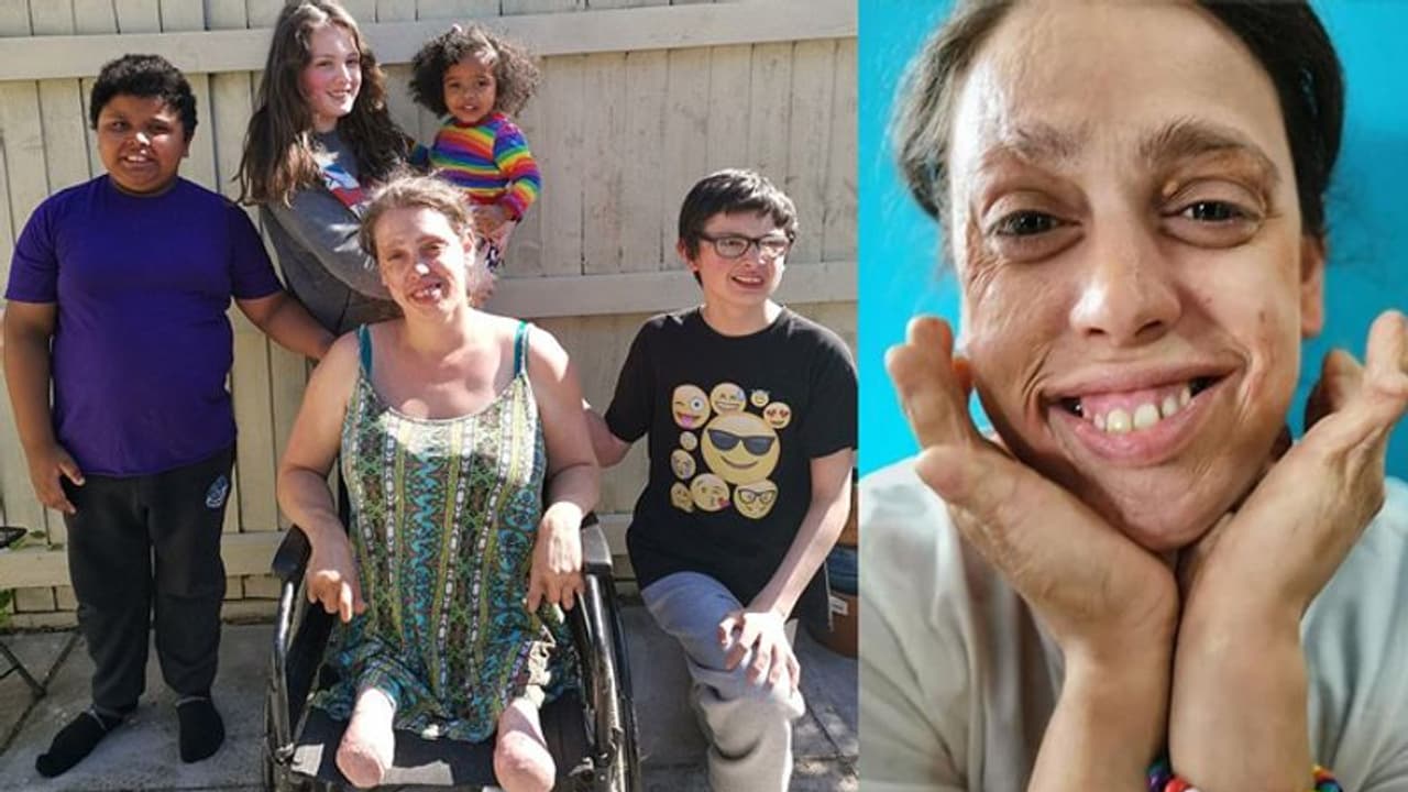 ഏഴുമാസം പ്രായമുള്ളപ്പോൾ തീപ്പൊള്ളലേറ്റ് രണ്ടു കാലുകൾ മുറിച്ചു നീക്കി, ഇന്ന് നാലു കുഞ്ഞുങ്ങളുടെ അമ്മ..! ഏഴുമാസം പ്രായമുള്ളപ്പോൾ തീപ്പൊള്ളലേറ്റ് രണ്ടു കാലുകൾ മുറിച്ചു നീക്കി, ഇന്ന് നാലു കുഞ്ഞുങ്ങളുടെ അമ്മ..!