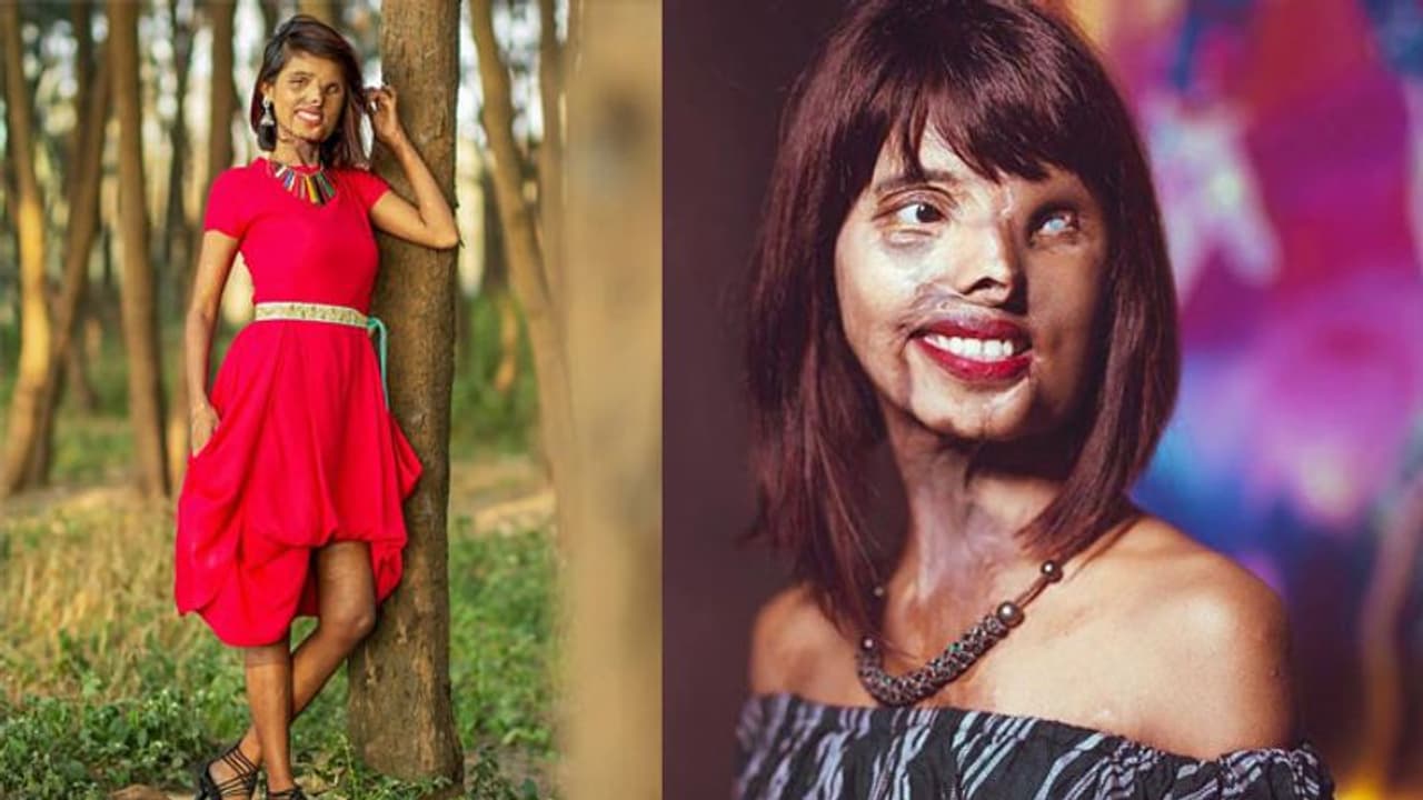 രണ്ട് മാസം മാത്രം പ്രായമുള്ളപ്പോള് അച്ഛന് അവളുടെ ദേഹത്ത് ആസിഡ് ഒഴിച്ചു; ഇന്നവള് അതിജീവനത്തിന്റെ പ്രതീകം രണ്ട് മാസം മാത്രം പ്രായമുള്ളപ്പോള് അച്ഛന് അവളുടെ ദേഹത്ത് ആസിഡ് ഒഴിച്ചു; ഇന്നവള് അതിജീവനത്തിന്റെ പ്രതീകം