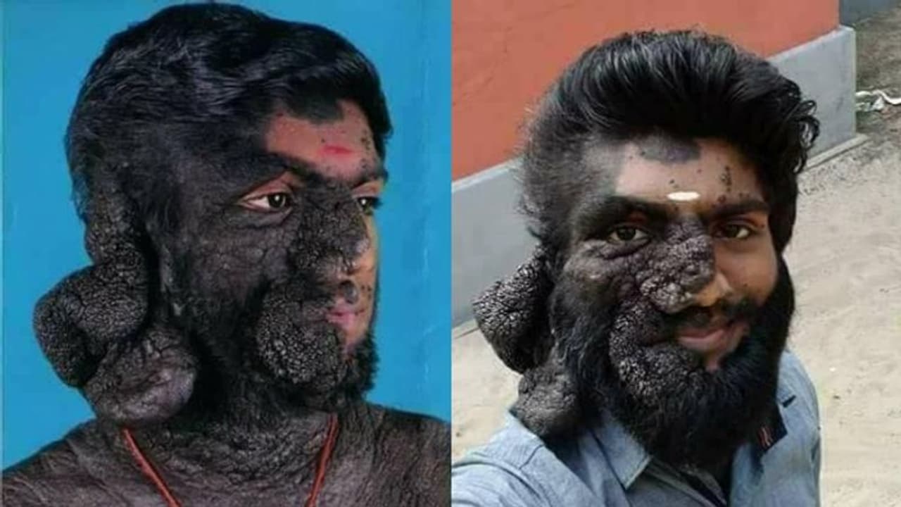 ശരീരത്തിന്റെ 80 ശതമാനവും കറുത്ത മറുക് കവർന്നെടുത്തു: സഹായം അഭ്യർത്ഥിച്ച് യുവാവ് ശരീരത്തിന്റെ 80 ശതമാനവും കറുത്ത മറുക് കവർന്നെടുത്തു: സഹായം അഭ്യർത്ഥിച്ച് യുവാവ്