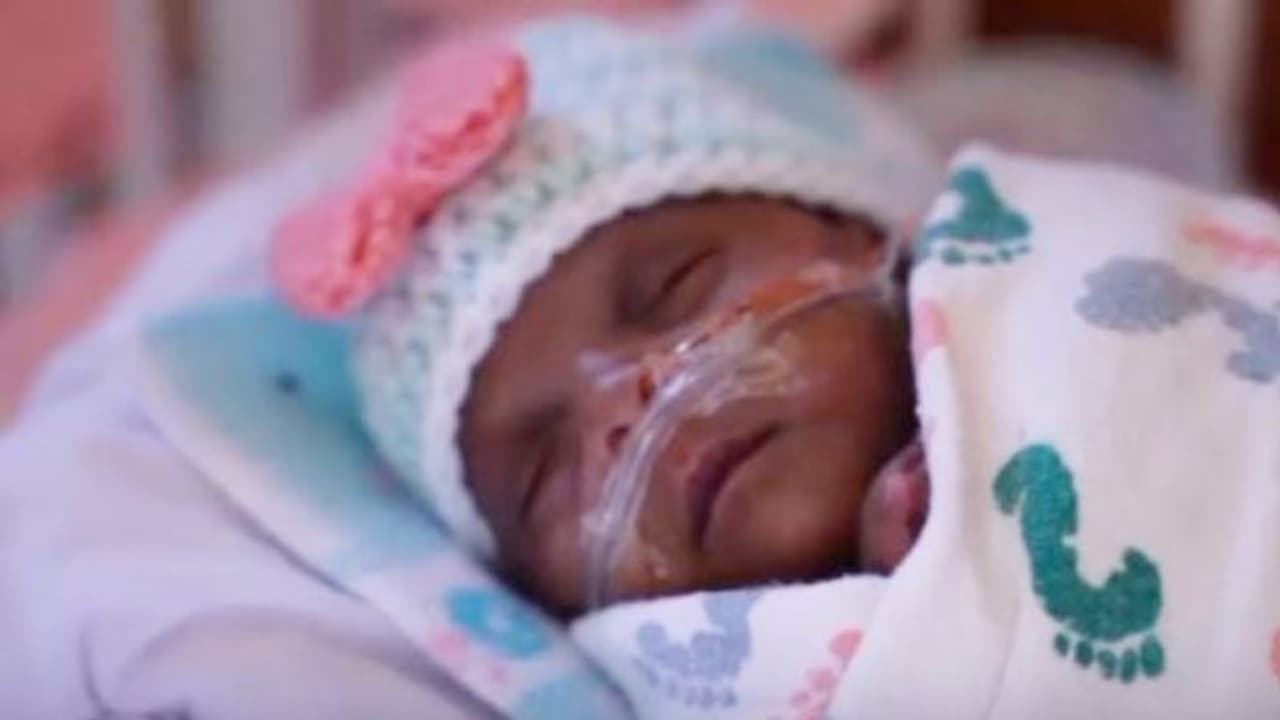 জন্ম নিল বিশ্বের ক্ষুদ্রতম শিশু, ওজন একটা বড় মাপের আপেলের মতো