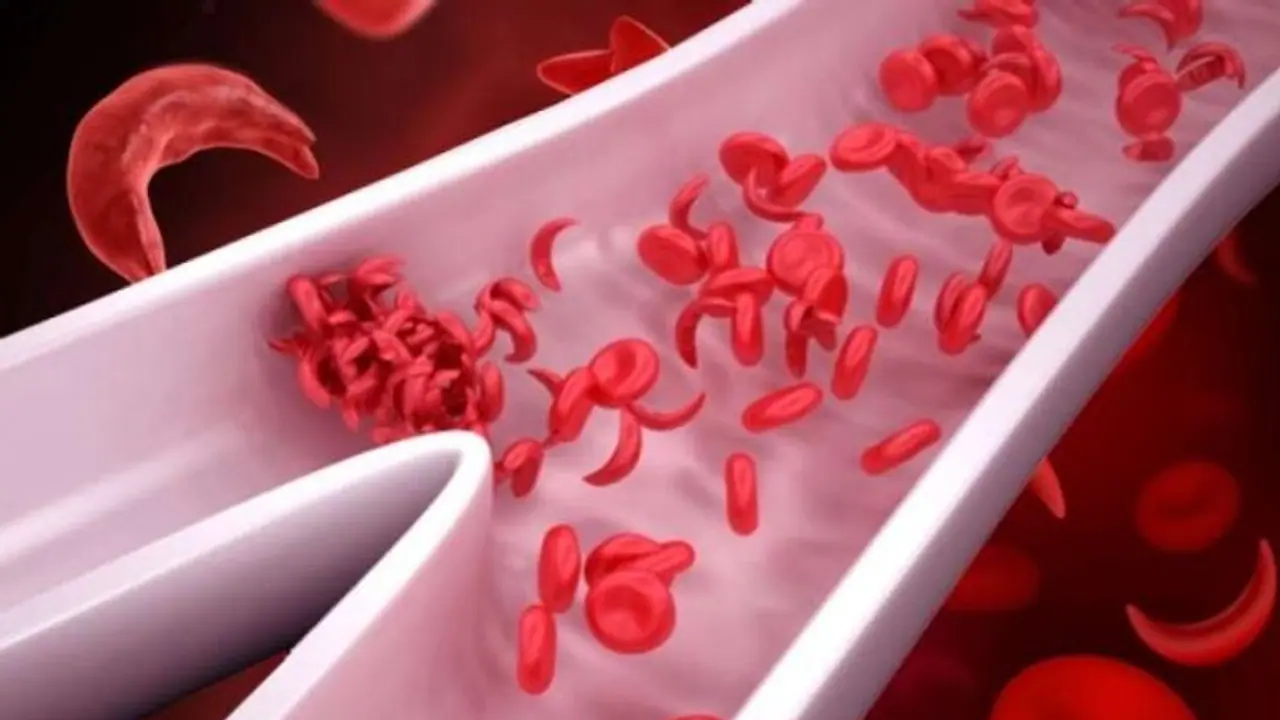 എന്താണ് അരിവാള് രോഗം? ലക്ഷണങ്ങൾ എന്തൊക്കെ? അറിയേണ്ടതെല്ലാം... എന്താണ് അരിവാള് രോഗം? ലക്ഷണങ്ങൾ എന്തൊക്കെ? അറിയേണ്ടതെല്ലാം...