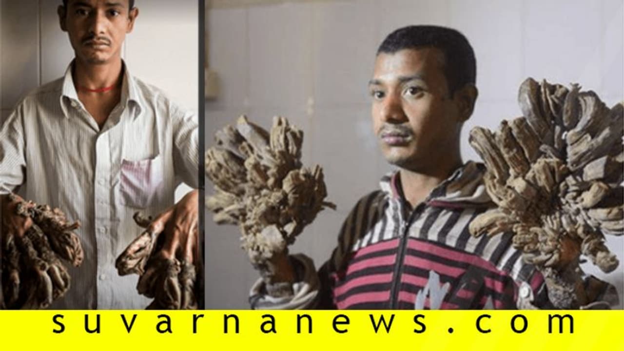 ನೋವು ತಡೆಯಲಾಗುತ್ತಿಲ್ಲ, ದಯವಿಟ್ಟು ನನ್ನ ಕೈ ಕತ್ತರಿಸಿ: 'ಟ್ರೀ ಮ್ಯಾನ್' ನೋವು ತಡೆಯಲಾಗುತ್ತಿಲ್ಲ, ದಯವಿಟ್ಟು ನನ್ನ ಕೈ ಕತ್ತರಿಸಿ: 'ಟ್ರೀ ಮ್ಯಾನ್'