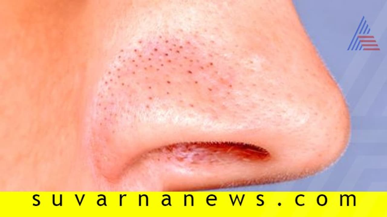 ಬ್ಲ್ಯಾಕ್ಹೆಡ್ಸ್ಗೆ ಹೇಳಿ ಬೈ ಬೈ! ಬ್ಲ್ಯಾಕ್ಹೆಡ್ಸ್ಗೆ ಹೇಳಿ ಬೈ ಬೈ!