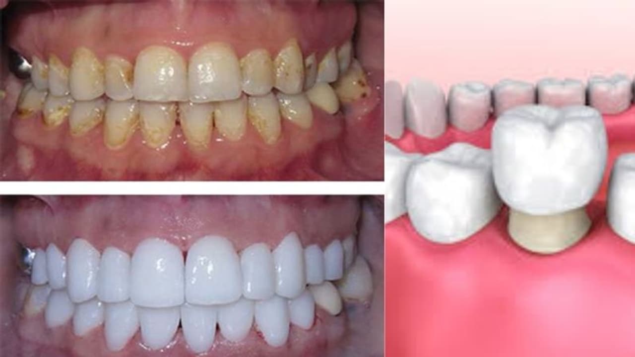 നിങ്ങളുടെ പല്ലിന് ക്യാപ്പിന്റെ ആവശ്യമുണ്ടോ? നിങ്ങളുടെ പല്ലിന് ക്യാപ്പിന്റെ ആവശ്യമുണ്ടോ?