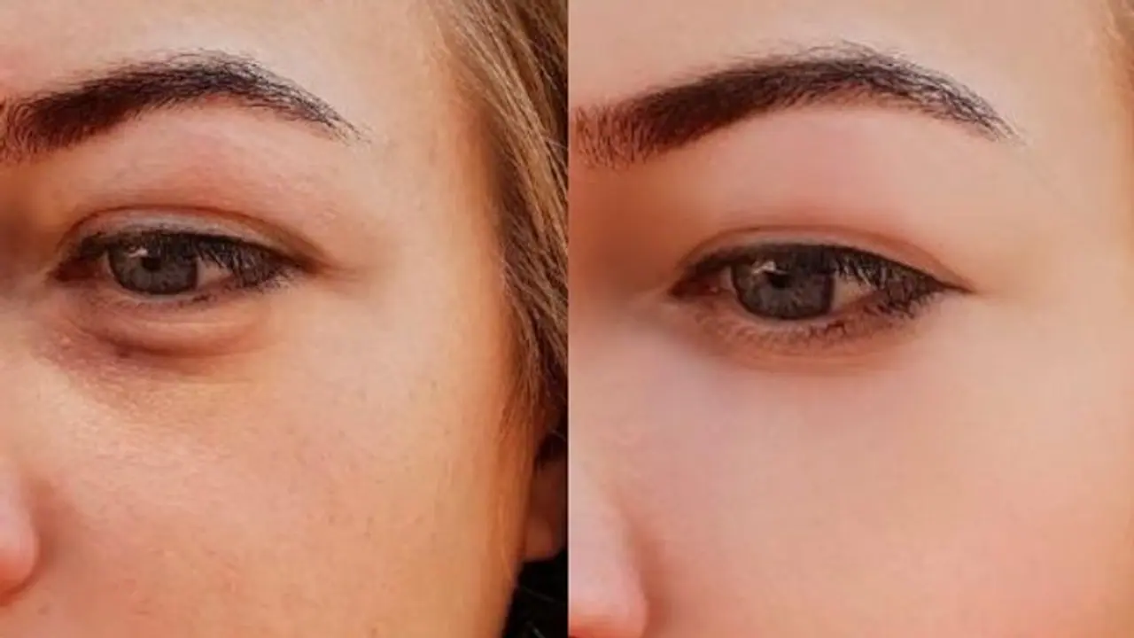 രാവിലെ എഴുന്നേല്ക്കുമ്പോള് കാണുന്നത് വീര്ത്ത കണ്ണുകളോ? പരിഹാരമുണ്ട്... രാവിലെ എഴുന്നേല്ക്കുമ്പോള് കാണുന്നത് വീര്ത്ത കണ്ണുകളോ? പരിഹാരമുണ്ട്...